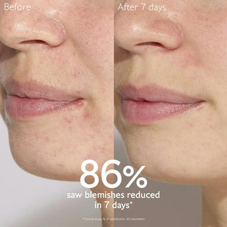 Vinopure Blemish Control Salicylic Serum 30ml