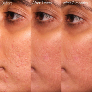 Vinopure Blemish Control Salicylic Serum 30ml
