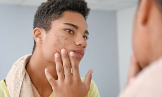 Acne Awareness Month: Treat & Prevent Acne